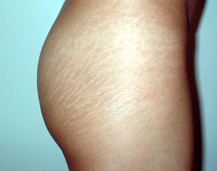 7 Ways To Deal With Stretch Marks