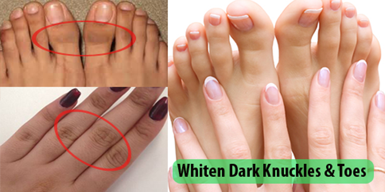 4 Home Remedies to Lighten Dark Finger and Toe joints