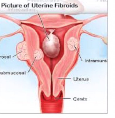 Painful sex could be early signs of Fibrod 