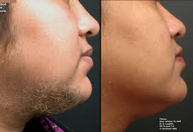 HOW TO GET RID OF FACIAL HAIR NATURALLY WITH NO SIDE EFFECTS